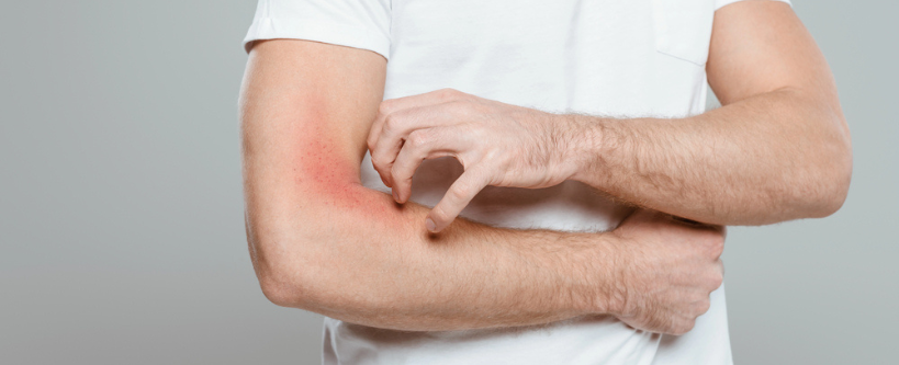 Cropped view of man scratching hand with allergy isolated on grey